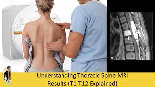 Upper Back Pain? Understanding Thoracic Spine MRI Results (T1-T12 Explained)