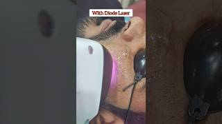 PERMANENT Laser Beard Shaping with Diode Laser #laserhairremoval #diodelaser #bikaner