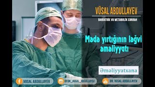 Dr.Vusal Abdullayev- Mədə yırtığının ləğvi əməliyyatı (refluks)