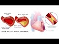 Acute Coronary Syndrome ACS  شرح بالعربى متلازمة الشريان التاجي الحادة