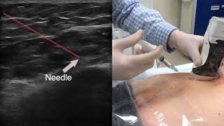 Dr. David Rosenblum: The Ultrasound Guided Superior Cluneal Nerve Block