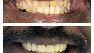 முழு வாய் புனரமைப்பு சிகிச்சை Full Mouth rehabilitation  @ Lefort Dental Hospital