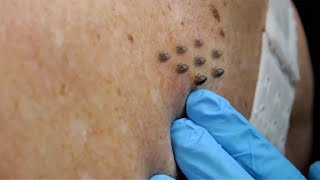 Extreme Blackhead Removal by Hand 2024