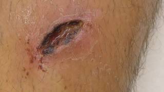 Use of Manuka Honey to heal a neglected wound which was left open for 13 days