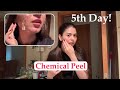 Chemical Peel 5th Day Condition | Skin Routine | Shilpa Chaudhary