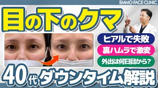 【40代の決断】ヒアルロン酸では改善せず…裏ハムラ手術に踏み切った結果！30日間のダウンタイム記録