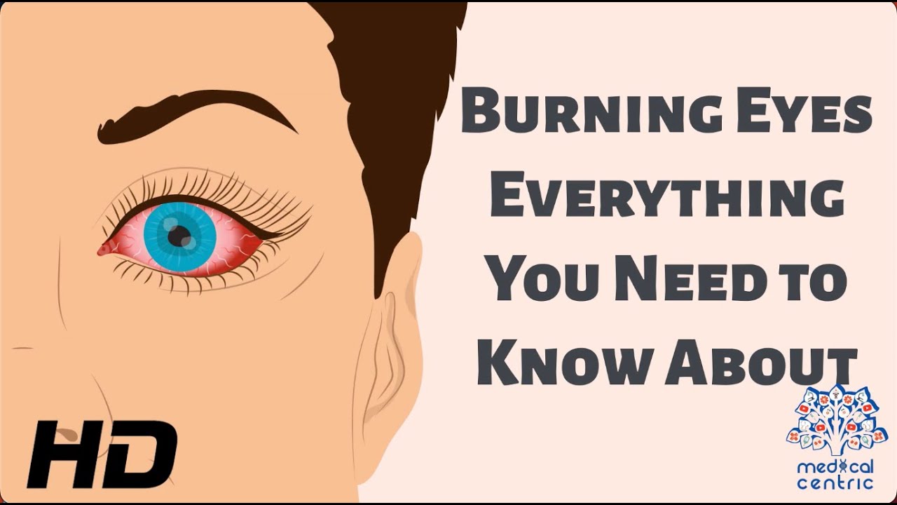 Burning Eyes: Everything You Need To Know - YouTube