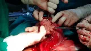 cs myomectomy ,DR ABDUL WAHAB