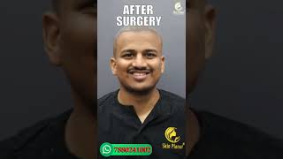 HAIR TRANSPLANT IN NAGPUR  / COST OF HAIR TRANSPLANT