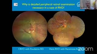 AIOC2021- GP70 - Topic - Dr.Avinash Pathengay - Retinal vein occlusion in young adults