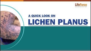 A patient's guide to understanding Lichen Planus