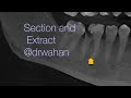 Extract this Brittle Lower Molar