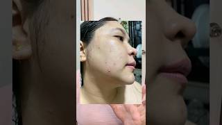 GRABE PIMPLES TO #pimples #ginseng #orientalherbal #renhe