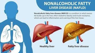 NAFLD: Non-Alcoholic Fatty Liver Disease
