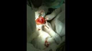 cesarean