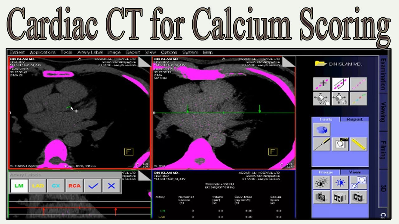 Cardiac CT For Calcium Scoring - YouTube