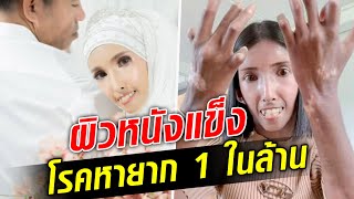 โรคหายากหนึ่งในล้าน ผิวหนังแข็ง ฝ่ามรสุมชีวิต เปิดใจเจอรักแท้  : Khaosod TV