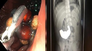 Docs remove 200 metal balls from toddler's stomach swallowed two months earlier