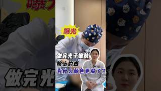 做完光子嫩肤脸上的斑为什么颜色更深了？#光子嫩肤