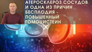 АТЕРОСКЛЕРОЗ СОСУДОВ И ОДНА ИЗ ПРИЧИН БЕСПЛОДИЯ - ПОВЫШЕННЫЙ ГОМОЦИСТЕИН