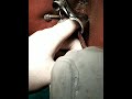 Fissure surgery ( Sphinterotomy)