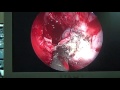 CSF leak from lateral recess of sphenoid UNEDITED ( Case 1 ) - Dr. Satish Jain - www.skullbase360.in