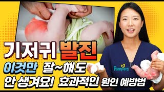 기저귀 발진 원인과 예방법! 그리고 기저귀발진 걱정을 줄여주는 여름기저귀가 필요한 이유는? (feat.팸퍼스)