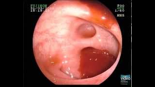 Diverticular Bleeding