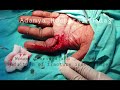 crush injury hand, open fractures pp index and middle fingers K-wire fixation, Adamya Hospital video