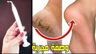 بشمعة واحدة وفي يوم واحد إليك الحال النهائي للتخلص من تشققات الأقدام