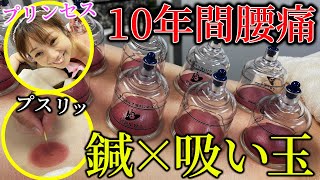 【吸い玉　整体】やばい瘀血でました　10年以上の腰痛が出張で悪化　吸い玉カッピング×鍼整体治療がおすすめ　自宅でできる方法も伝授 【横浜元町　銀座日本橋　鍼灸院】