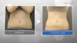 Scizer - Permanently eradicate fat cells MFSU Technology before \u0026 after