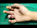 Tendon repair - Zone 1(#tendonsurgery #handsurgery #handsurgeon #fingerinjury) @Kumardaj