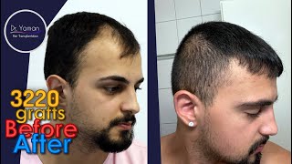 Dr Resul Yaman Hair Clinic - 3220 Grafts Before - After