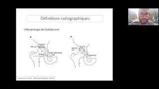 Dewi GUELLEC  Dysplasie de hanche de l'adulte