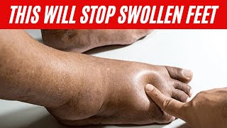 Home Remedies for Swollen Feet | Edema Remedy