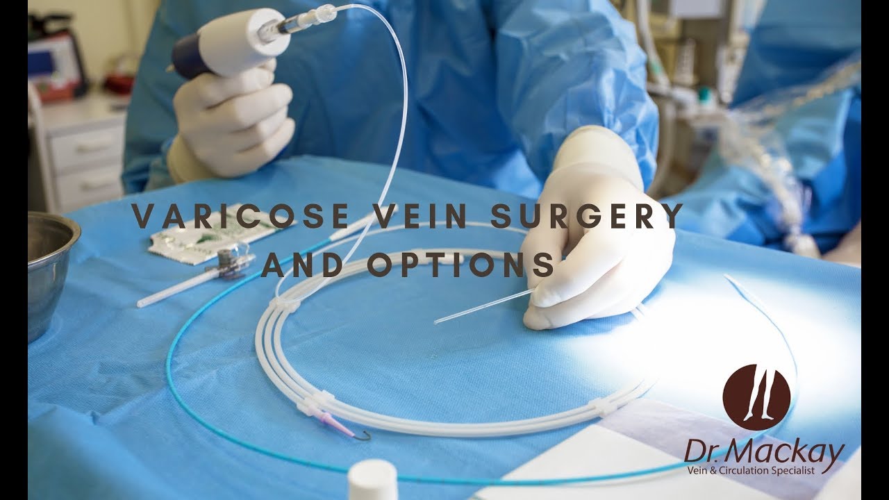 About Varicose Vein Surgery And The Options With Dr. Mackay - YouTube