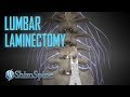 Lumbar Laminectomy