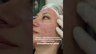 Mesogel Jalupro injection technique, skin rejuvenation, lifting effect and improvement of skin color