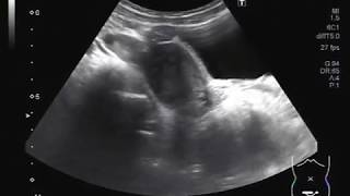 Ultrasound Video showing a large cervical cyst.