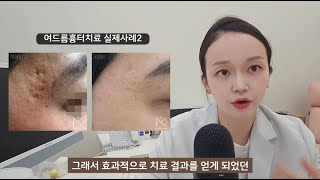 패인 여드름흉터, 붉은 여드름자국 홈케어로 가능한 경우와 피부과를 꼭 가야 하는 경우 (여드름흉터 없애는법, 여드름흉터레이저, 여드름흉터시술)