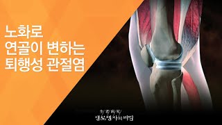 노화로 연골이 변하는 퇴행성 관절염 - (2011.10.29_389회 방송)_중년여성, 무릎관절이 무너진다