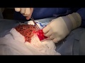 Gastrotomy surgery!