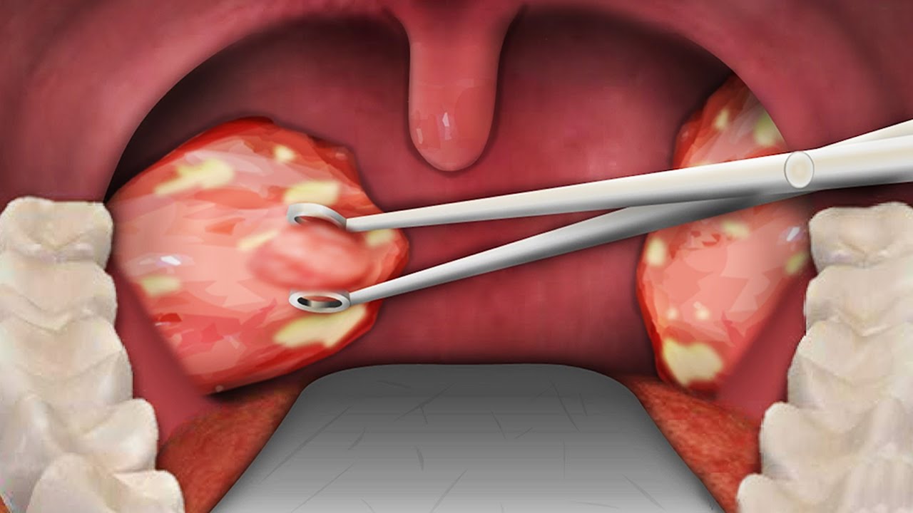 Tonsillectomy Procedure Step By Step Tonsillectomy Surgery In