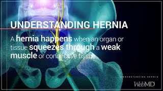 The Basics: Hernias | WebMD