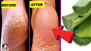 ส้นเท้าแตกรักษาอย่างไร? แจกสูตรเด็ด! เห็นผลทันใจ 100%, Remove Cracked Heels|Nee Nurse Beauty