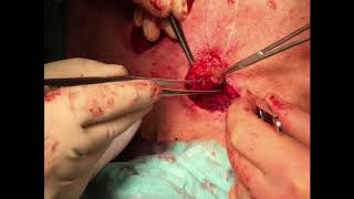 Closure of Tracheocutaneous Fistula After Prolonged Tracheostomy