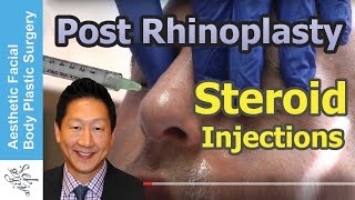 Live Demo Post Rhinoplasty Steroid Kenalog Injections for Swelling, Healing by Seattle Dr.Young