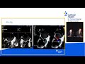 hv team discussion mitral surgery vs. mitraclip