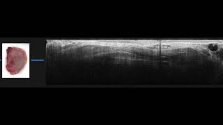 Real-Time Volumetric Analysis of Intraoperative Wide-Field Optical Coherence Tomography Imaging Data